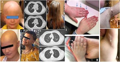 The Safety and Efficacy of Tofacitinib in 24 Cases of Pediatric Rheumatic Diseases: Single Centre Experience